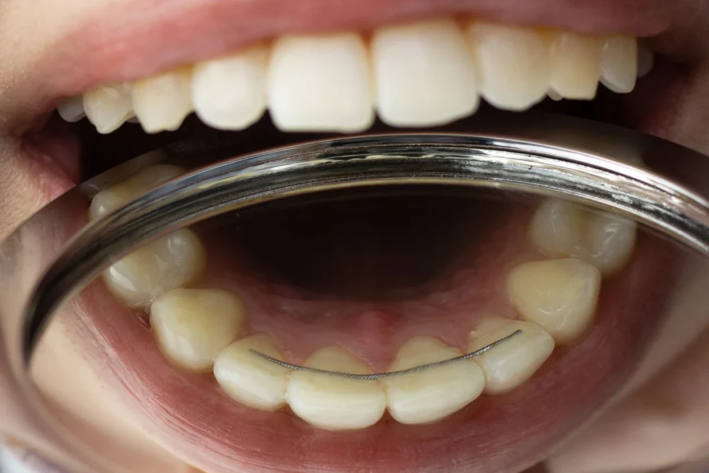 Contentions dentaires après traitement orthodontique Vourles près de Lyon Dr Kelly TILLY