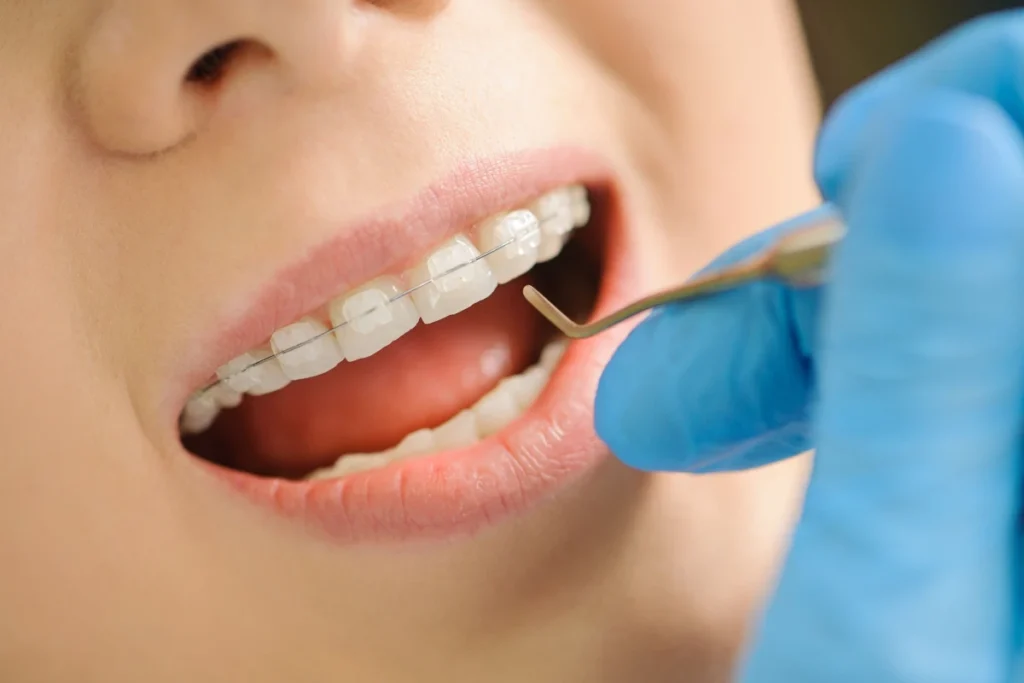 Orthodontiste adolescent Vourles Lille Multi-attaches