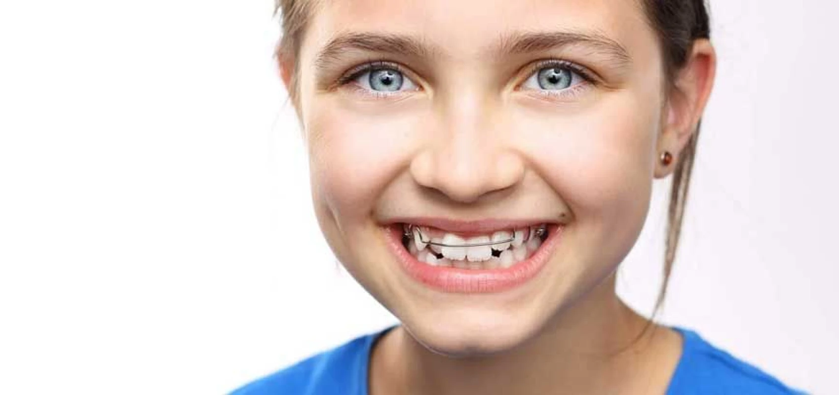 Orthodontie précoce enfant à Vourles – activateur, plaque palatine, disjoncteur – Dr Kelly TILLY