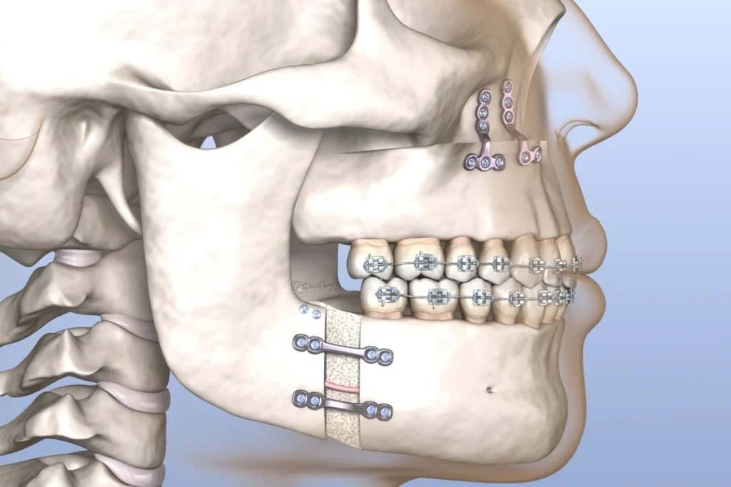 Orthodontiste adolescent Vourles Lille Traitements ortho-chirurgicaux