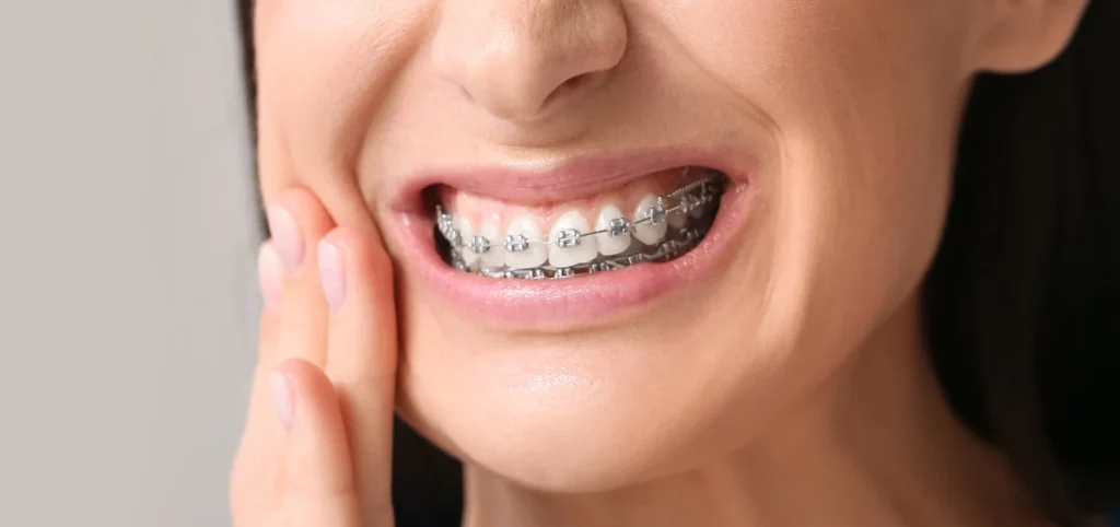 orthodontie à Vourles